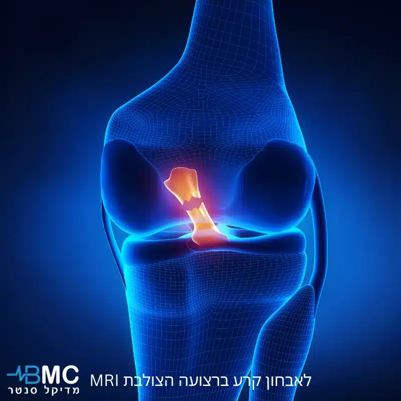 MRI לאבחון קרע ברצועה הצולבת תמונה ראשית - BMC מדיקל סנטר