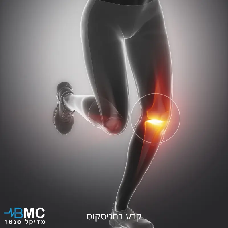כאב בברך כתוצאה מקרע במניסקוס בזמן ריצה ופעילות גופנית
